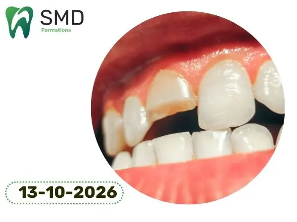 Restaurations composites directes sur les dents antérieures : de la stratification aux facettes complètes